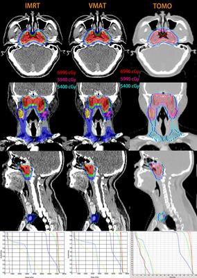 Comparison of Dosimetric Benefits of Three Precise Radiotherapy Techniques in Nasopharyngeal Carcinoma Patients Using a Priority-Classified Plan Optimization Model